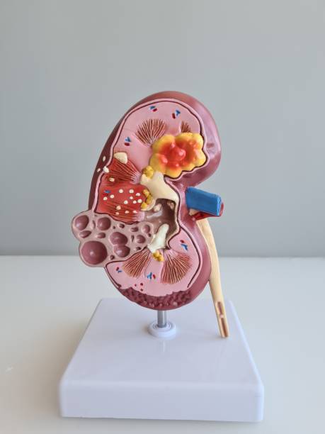 istock Urolithiasis and human a kidney anatomy closeup 1410321671