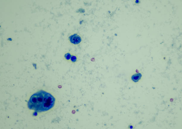 Urothelial carcinoma, high grade.  High-grade tumors have an aggressive appearance under a microscope and are assumed invasive in the kidney or ureter.