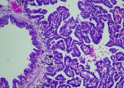 Adenocarcinoma, predominantly papillary type, lung