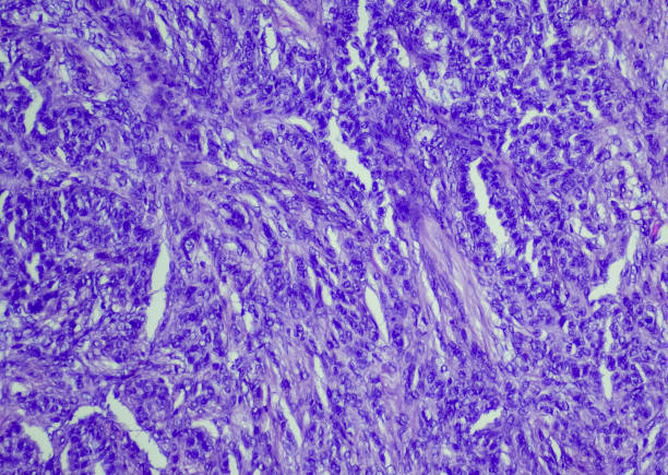 tumor de células de la granulosa adulta. sitio: ovario. - ovary human cell cell high scale magnification fotografías e imágenes de stock