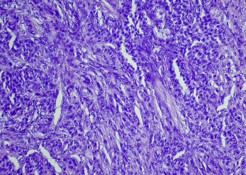 Adult granulosa cell tumor. Site: ovary. Granulosa cell tumor of the ovary is a rare type of ovarian cancer. This type of tumor is known as a sex cord-stromal tumor and usually occurs in adults.