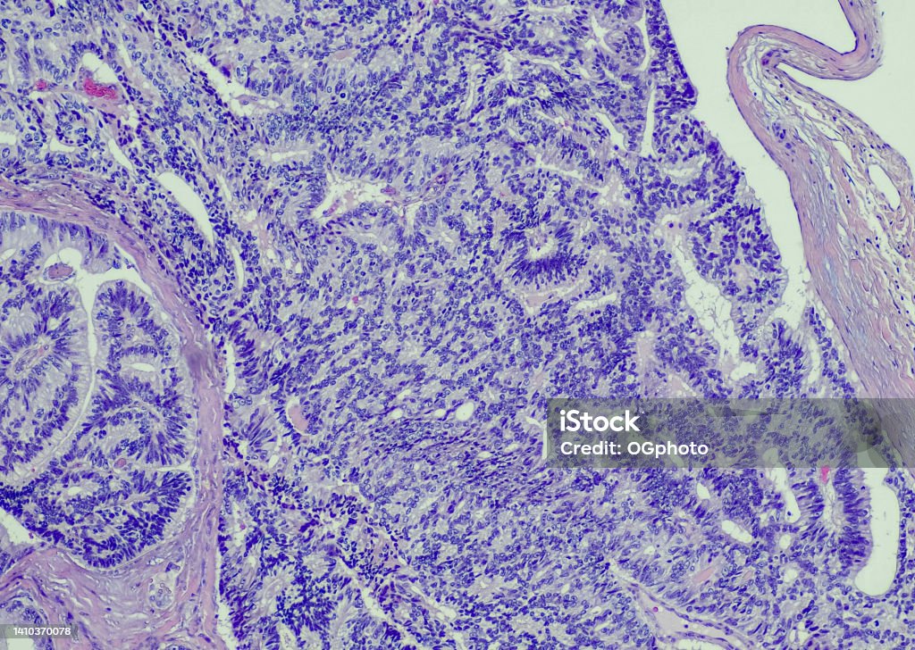 Metastatic prostate to right testis Metastatic prostate to right testis. Prostate cancer may spread to the testis due to retrograde venous extension, embolism, arterial embolism, lymphatics, or endocanalicular spread. Prostate Cancer Stock Photo