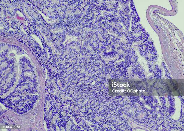 Metastatic Prostate To Right Testis Stock Photo - Download Image Now - Prostate Cancer, Prostate Gland, Cancer - Illness