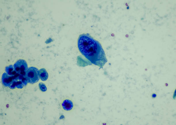 Urothelial carcinoma, high grade.  High-grade tumors have an aggressive appearance under a microscope and are assumed invasive in the kidney or ureter.