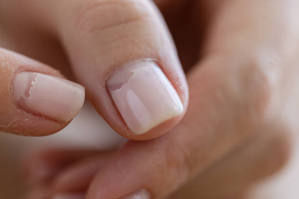 istock Cracked broken nail closeup. Nail weakness damage from gel polish coating. 1410455810