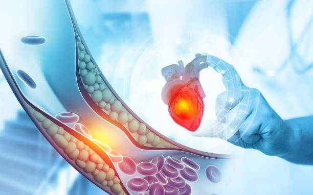 istock Cholesterol plaque in artery on science background. 3d illustration 1410458420