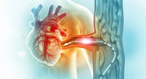 심장 카테터 삽입 절차. 스텐트 혈관 성형술. 3d 일러스트레이션 - angioplasty 뉴스 사진 이미지