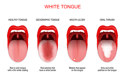 Sore or white tongue. comparison of healthy tongue and oral disease: Geographic tongue, Mouth ulcer and Oral thrush. Vector poster for medical use