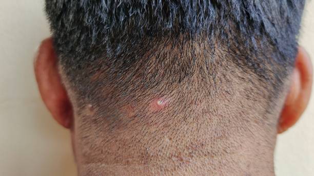 The Inflammation acne skin on the head Portrait showing the Inflammation acne skin on the head, problem rough skin on the neck of the male, concept health care. mycobacterium leprae stock pictures, royalty-free photos & images