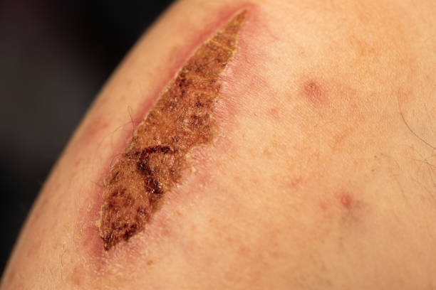 A large dried scab on a man's arm. The injury resulted from a bicycle accident. scab arm stock pictures, royalty-free photos & images