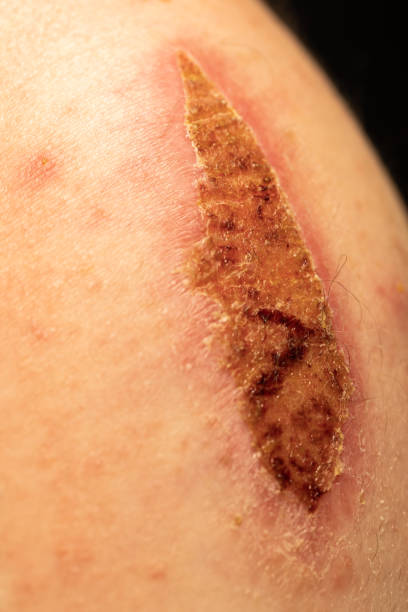 A large dried scab on a man's arm. The injury resulted from a bicycle accident. scab arm stock pictures, royalty-free photos & images