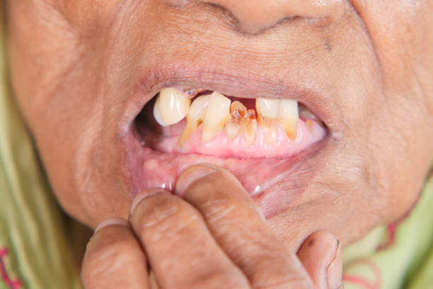femme aîné souriant avec des dents déformées - dentist office dentists chair dentist dental hygiene photos et images de collection