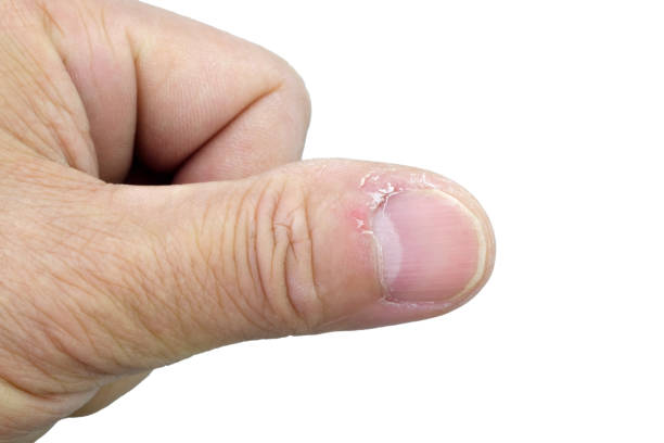 Extreme Close Up Of A Dry Skin Thumb Stock Photos, Pictures & Royalty-Free  Images - iStock