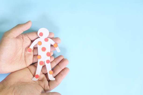 istock Pox disease such as monkeypox, smallpox and chicken pox care, prevention and protection concept. Hand holding human body cutout with red rash sores and blisters on skin in blue background. 1410723859