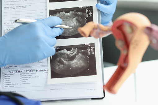 Close-up of female doctor pointing at ultrasound analysis of ovary, transvaginal ultrasound of uterus. Scientific diagram, gynecological analysis concept