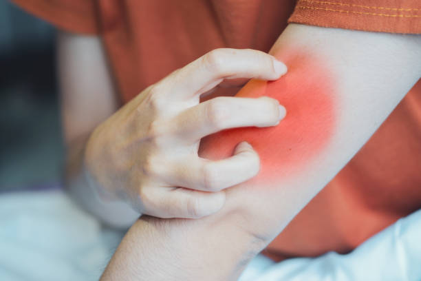 istock Woman scratching her arm due to irritation from insect bites. 1410766328