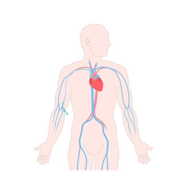 男性体に末梢に挿入された中央カテーテルpiccの - surgery catheter cardiac catheterization hospital点のイラスト素材／クリップアート素材／マンガ素材／アイコン素材