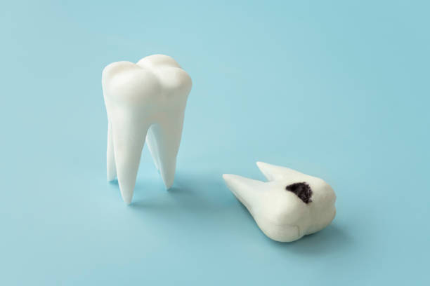 istock a sick and healthy tooth concept. Teeth with bad sick damaged tooth on blue background. Decay, gum disease. Stomatology, dental problem, poor oral hygiene concept. 1410855098