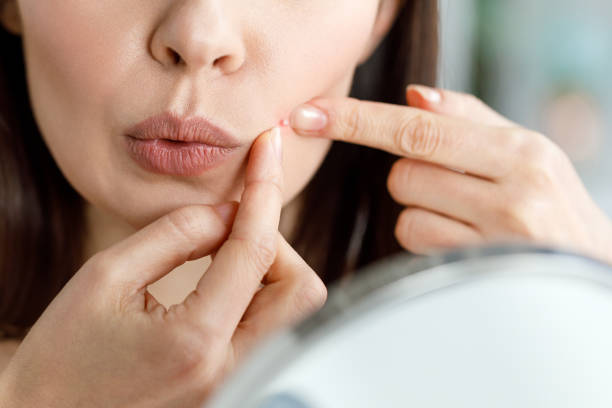 istock A woman crushes a pimple while looking in the mirror. 1410922569