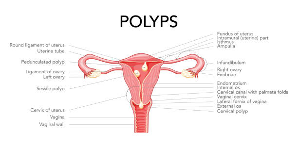 istock Polyp in the uterus with inscriptions diagram Female reproductive system in cross sections. Front view in a cut. Human anatomy diseases internal organs location scheme, cervix, ovary flat style icon 1411068199