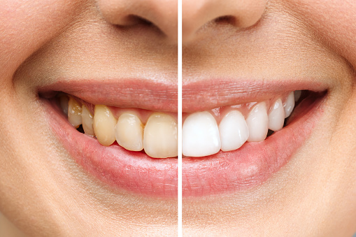 Teeth before and after whitening. Over white background. Dental clinic patient. Image symbolizes oral care dentistry, stomatology