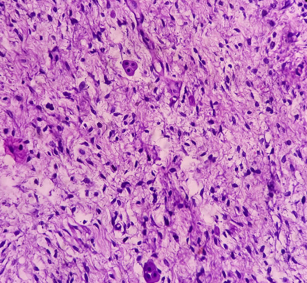 Tissue from tail of cat: Neurofibroma, benign neoplasm of spindle shaped cells with wavy nuclei. Neurofibromatosis, microscopic 40x view. Tissue from tail of cat: Neurofibroma, benign neoplasm of spindle shaped cells with wavy nuclei. Neurofibromatosis, microscopic 40x view. endothelial stock pictures, royalty-free photos & images