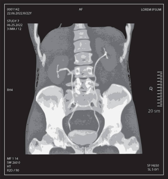 istock x-ray of human abdomen with pelvic bone and spine 1411233248