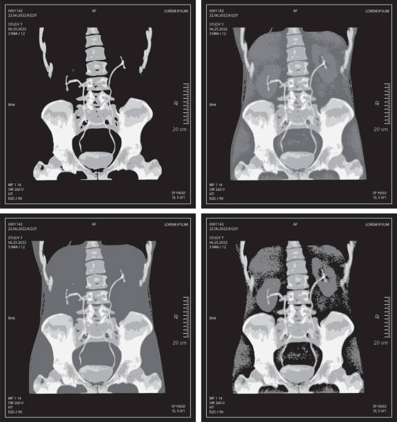 ilustraciones, imágenes clip art, dibujos animados e iconos de stock de radiografía vectorial establecida del abdomen humano con hueso pélvico y columna vertebral - cat scan abdomen medical scan x ray