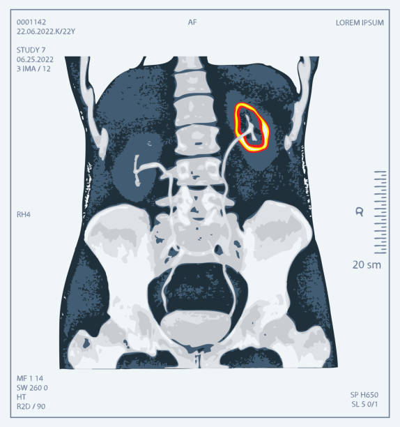 ilustraciones, imágenes clip art, dibujos animados e iconos de stock de radiografía del abdomen humano con hueso pélvico y columna vertebral - cat scan abdomen medical scan x ray