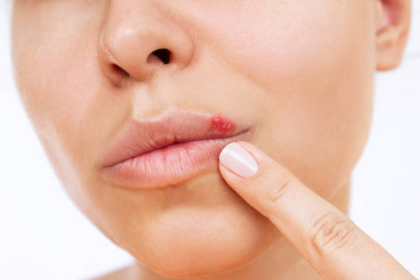 Herpes on the lip. Young woman points at blisters caused by virus on the mouth with her finger Herpes on the lip. Young woman points at blisters caused by virus on the mouth with her finger isolated on a white background. Itching and redness on the girl's face shingles rash stock pictures, royalty-free photos & images