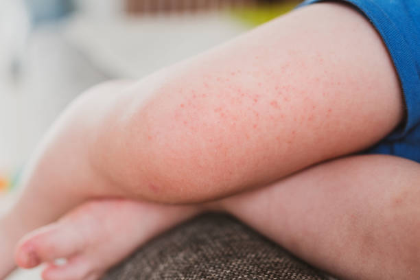 food allergies, eczema, or diathesis in a small child on the legs stock photo