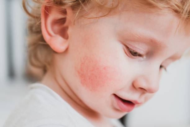 food allergy in a young child on the cheeks stock photo