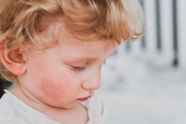 food allergy in a young child on the cheeks stock photo