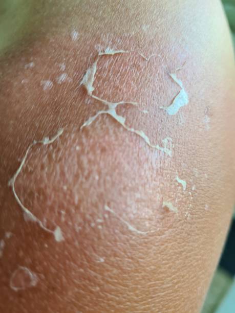 texture of irritated unhealthy skin with scales of dead cells - peel off imagens e fotografias de stock