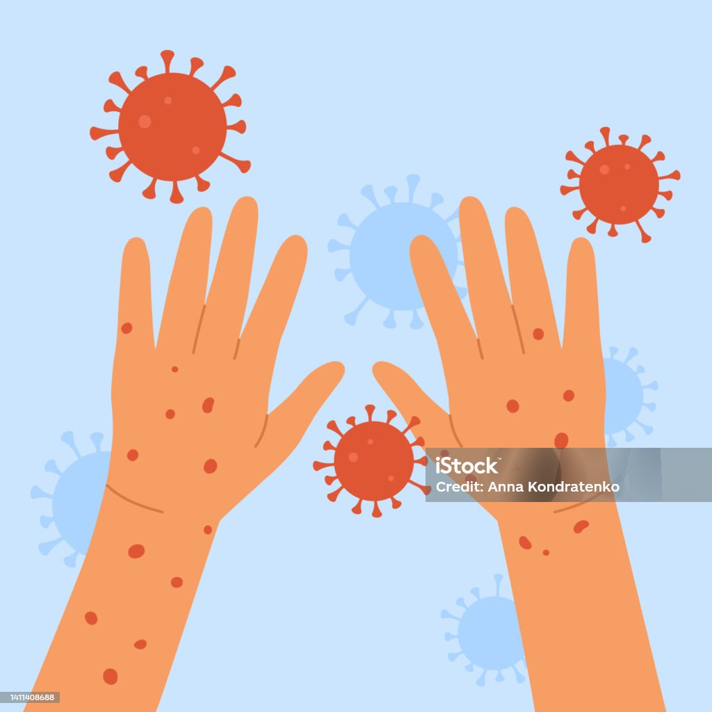 Smallpox Rash Cartoon Monkeypox Virus Human Hands With Monkeypox Skin Infection Concept An ...