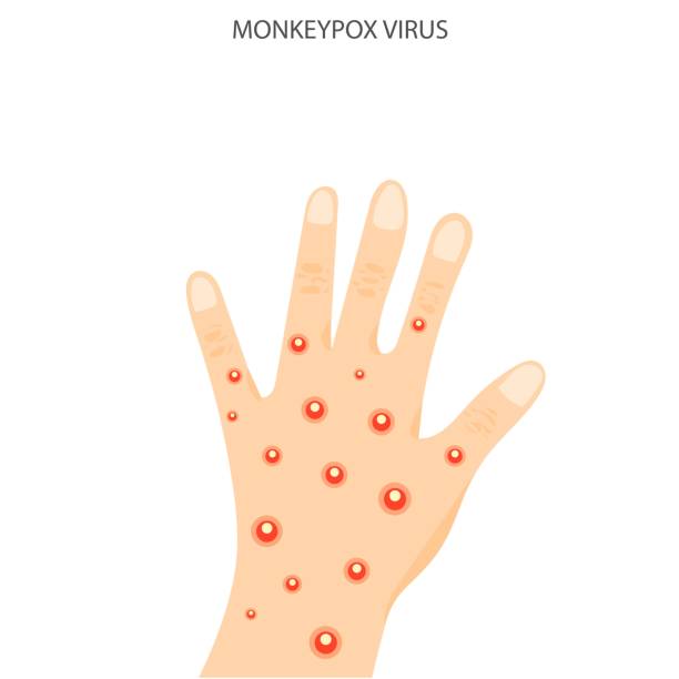 Smallpox Hand Image 250+ Smallpox Hand Stock Illustrations, Royalty-Free Vector Graphics ...