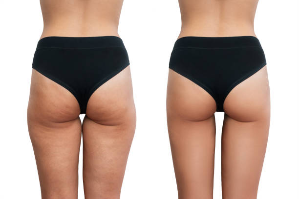 치료 전후에 셀룰 라이트가있는 젊은 여성의 허벅지가 흰색 배경에 격리되었습니다. - women human leg body buttocks 뉴스 사진 이미지