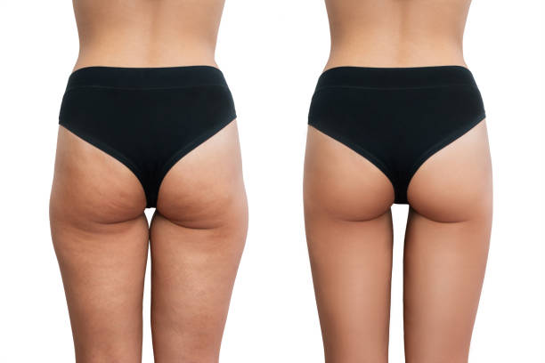 Young woman's thighs with cellulite before and after treatment isolated on white background Young woman's thighs with cellulite before and after treatment isolated on white background. Getting rid of excess weight. Result of diet, sports, massage, scrub, wellness. Improving the skin on legs cellulite stock pictures, royalty-free photos & images