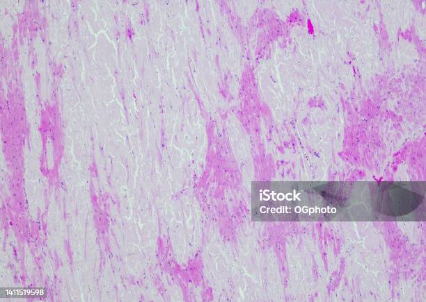 Hereditary Amyloidosis Cardiac Cardiac Amyloidosis May Affect The Way Electrical Signals Move Through The Heart Stock Photo - Download Image Now
