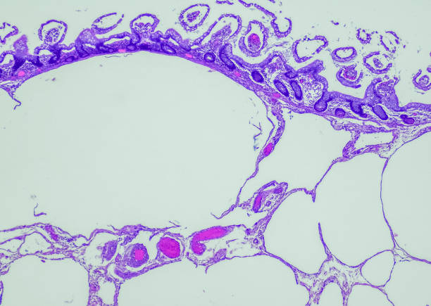 Pneumatosis cystoides intestinalis neumatosis cystoides intestinalis. la neumatosis cystoides intestinalis (pci) es una enfermedad rara caracterizada por la presencia de quistes gaseosos que contienen nitrógeno, hidrógeno y dióxido de carbono en la pared intestinal que pueden ser iatrog�