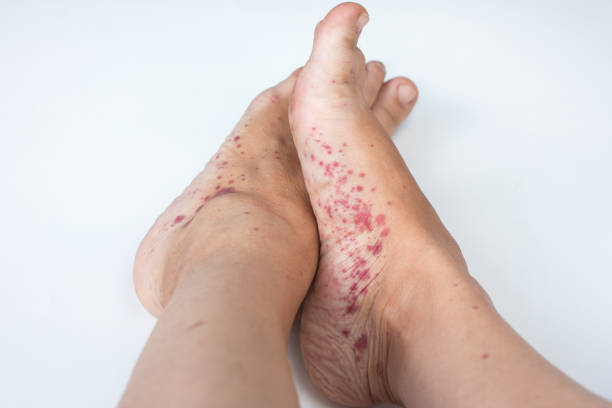 Infectious disease of the legs. Foot fungus and allergic rash Infectious disease of the legs. Foot fungus and allergic rash shingles rash stock pictures, royalty-free photos & images
