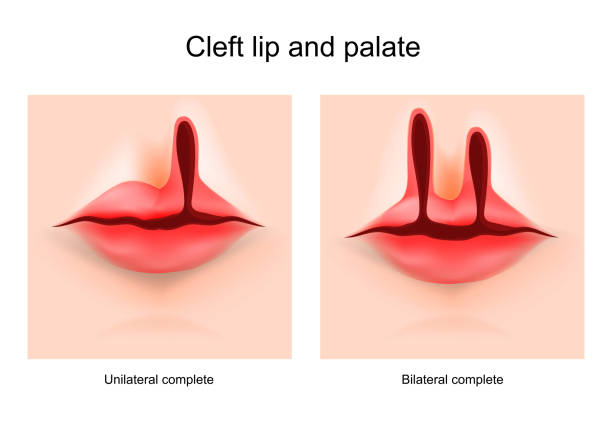 Cleft lip and cleft palate Cleft lip and cleft palate. face of a child with a defect cleft. Hare-lip. Unilateral and bilateral complete. Vector poster cleft lip stock illustrations
