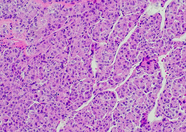Alveolar soft part sarcoma stock photo