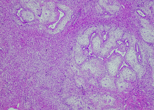 Mesenchymal hamartoma is a rare, benign, developmental tumor of the liver, with occasional risk of malignancy.
