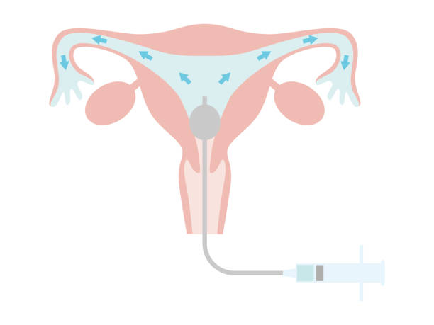 불임 치료를위한 히스테로 살핑 그래피. 조영제가 자궁에 놓이는 상태. - vagina uterus human fertility x ray image stock illustrations