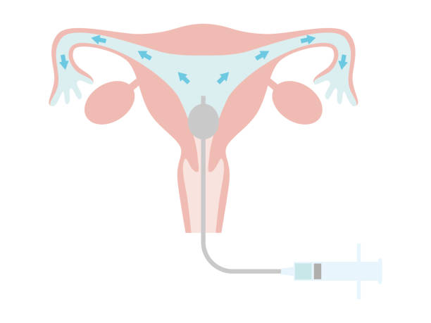 Hysterosalpingography for fertility treatment. A state in which a contrast medium is placed in the uterus. Hysterosalpingography for fertility treatment. A state in which a contrast medium is placed in the uterus. fallopian tube stock illustrations