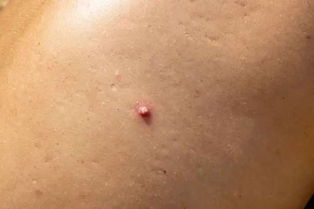 Close-up of a red swollen pimple on the skin of a woman's back showing hidradenitis suppurativa. Young woman with pore obstruction due to traces of sebum or dirt