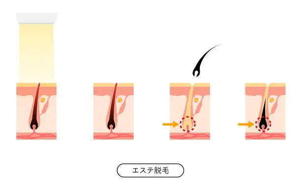 Vector illustration of Image of hair removal, the process of hair removal after esthetic hair removal treatment