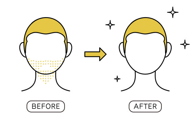ilustrações, clipart, desenhos animados e ícones de imagem antes e depois do tratamento de depilação da barba, do barba à pele lisa - stubble