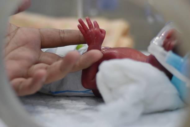 New born baby treated in incubator.